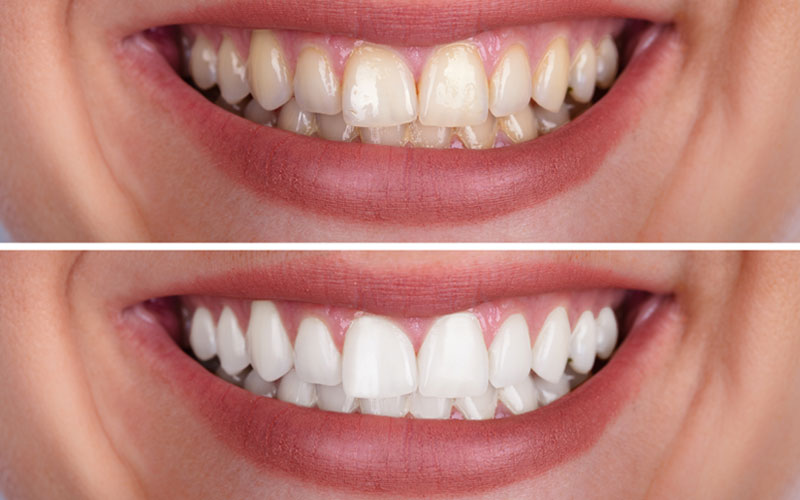 Zoom Whitening