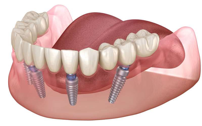 Prosthesis All On Four Implant 