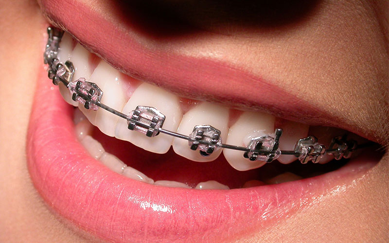 Orthodontic Treatment