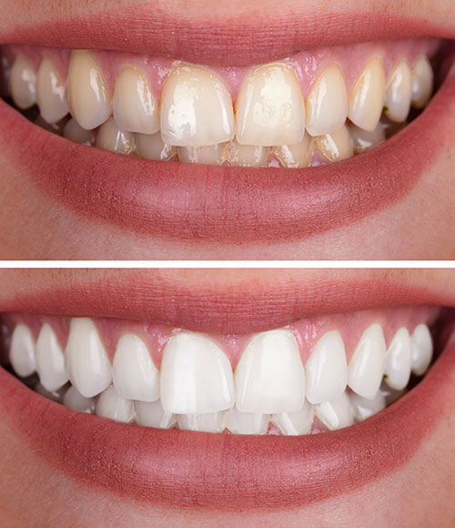 Zoom Whitening