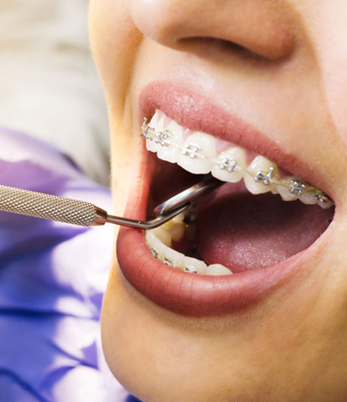 Orthodontic Treatment